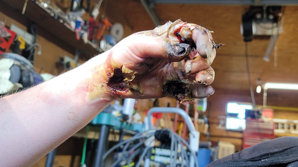 Fractal Wood Burning Injury